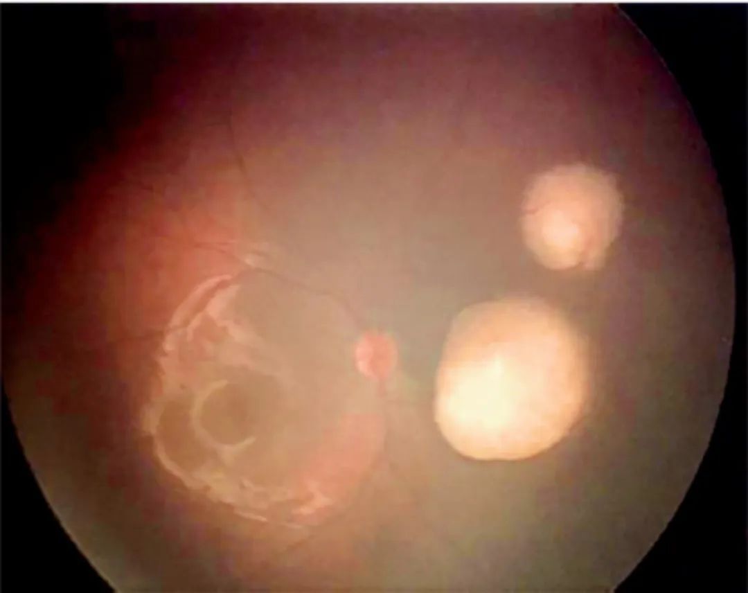 「猫眼症」之殇，眼里夺命肿瘤的背后来路......