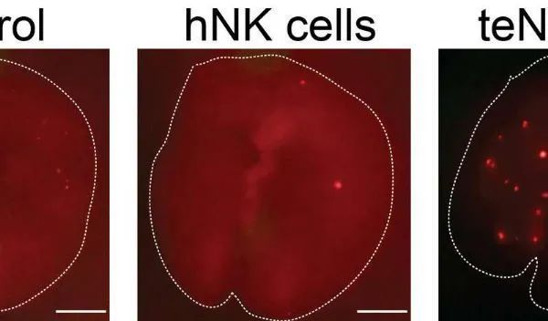 乳腺癌细胞可以改变NK的免疫细胞的功能