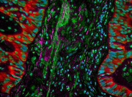 肺部肿瘤与免疫系统之间新型的相互作用机制