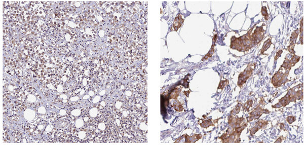 Atlas Antibodies公司乳腺癌预后良好相关的具有重要意义的基因指标