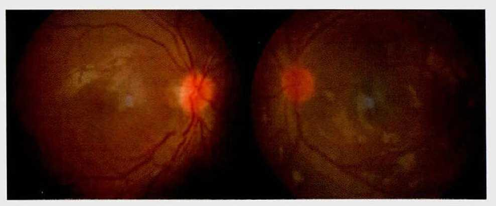 Leber遗传性视神经病变的诊断与治疗【罕见病并不罕见】