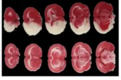 重磅推介丨脑卒中课题研究必看！缺血性脑卒中疾病研究整体解决方案