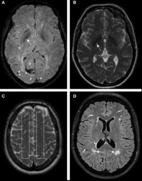 重磅推介丨脑卒中课题研究必看！缺血性脑卒中疾病研究整体解决方案