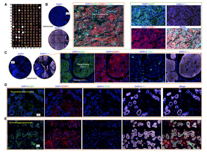 119 例临床样本验证 | Tissue Cytometry 技术锁定乳腺癌 CD47/αvβ3 共稳定关键,推动癌症免疫治疗突破