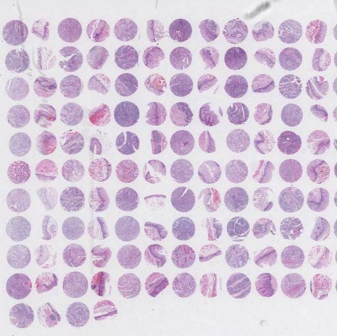 食管癌组织芯片