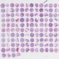 食管癌组织芯片