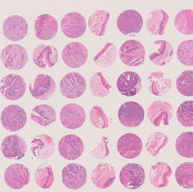 食管癌组织芯片 30例