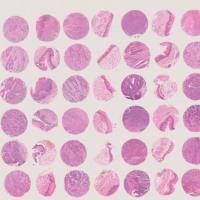 食管癌组织芯片 30例