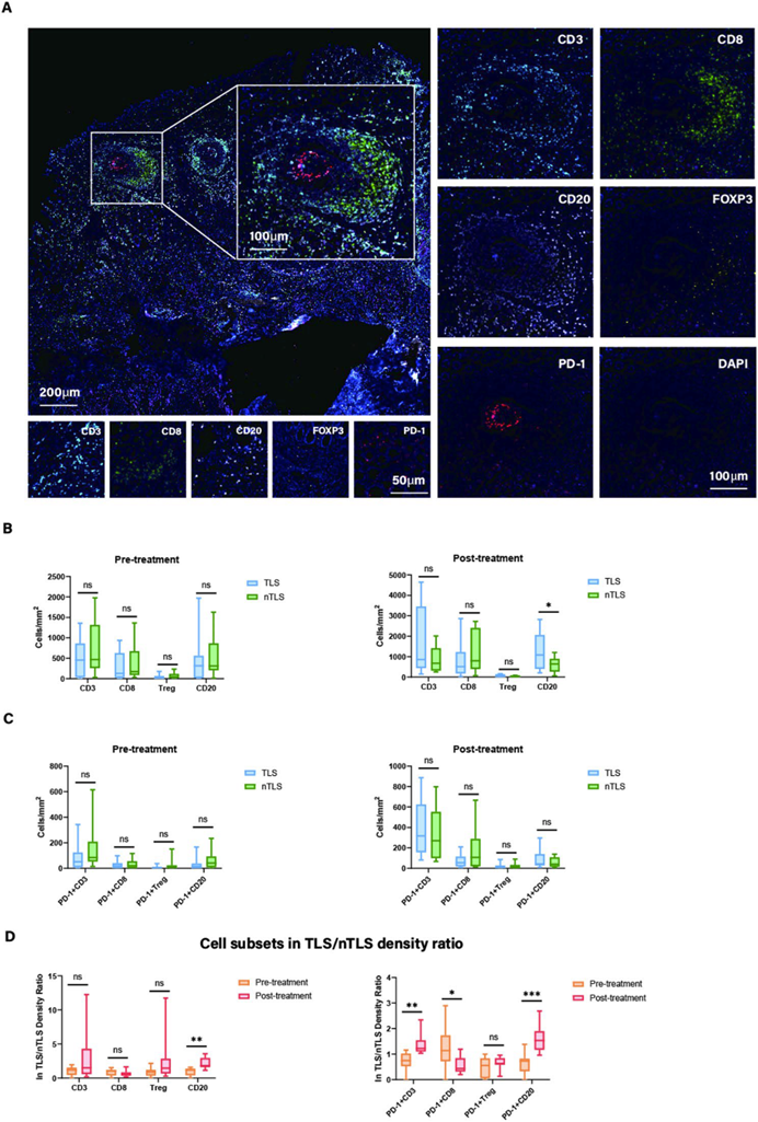 双指标联动| PD-1+Treg/PD-1+CD8 比值与 三级淋巴结构TLS 在晚期胃癌术前治疗中的预后及响应关联
