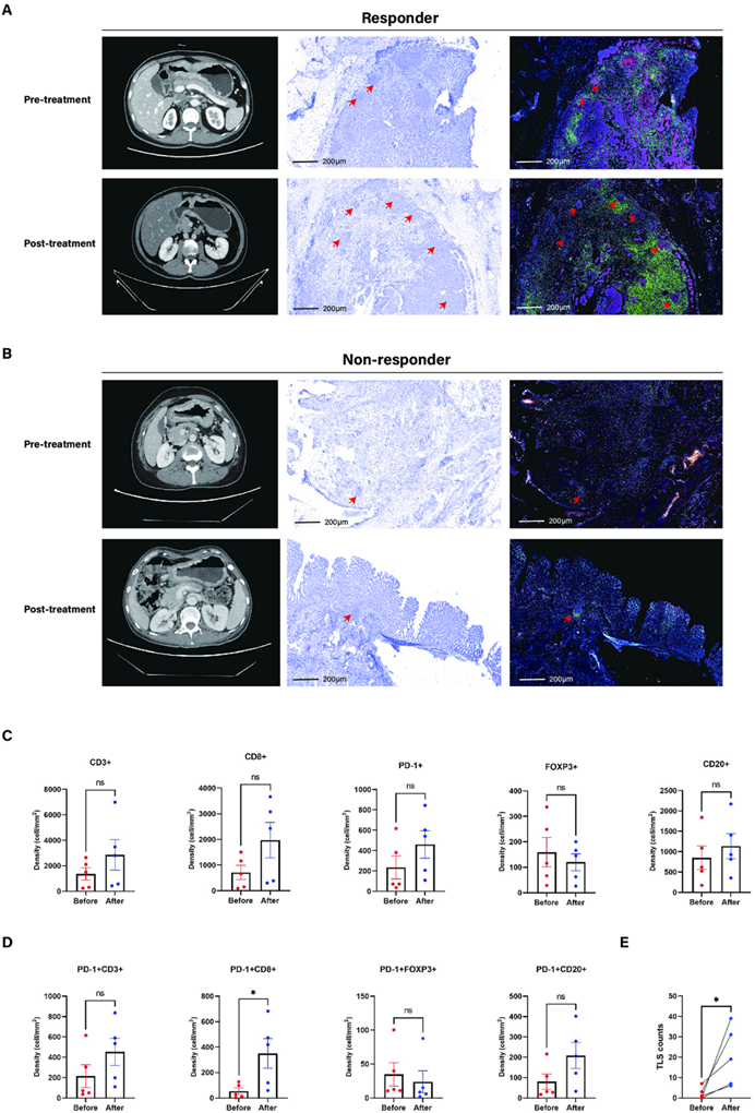 双指标联动| PD-1+Treg/PD-1+CD8 比值与 三级淋巴结构TLS 在晚期胃癌术前治疗中的预后及响应关联