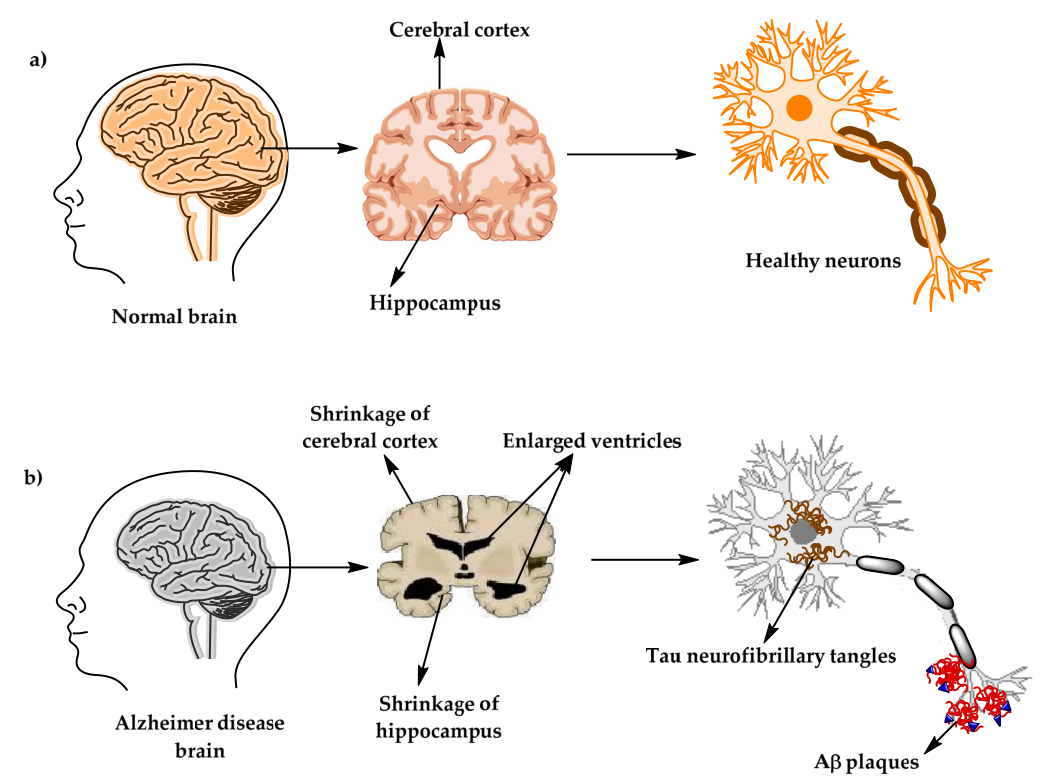 肠道菌群失调与老年痴呆的病理关联及治疗前景