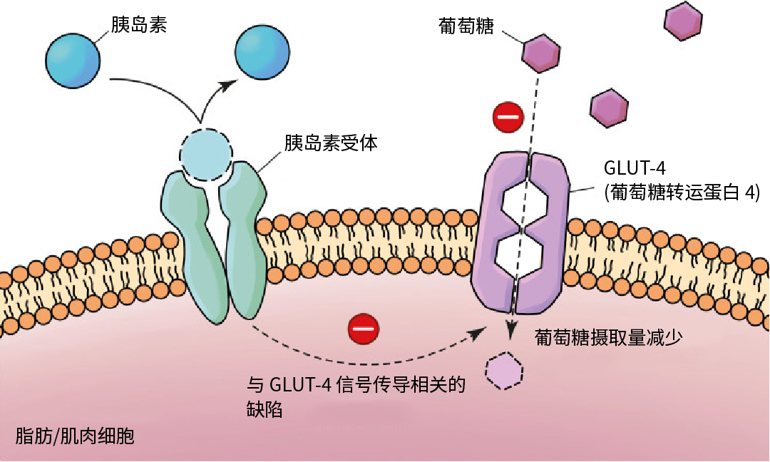 科研助攻 ｜ 2 型糖尿病∶ 机制、治疗策略和建模方法