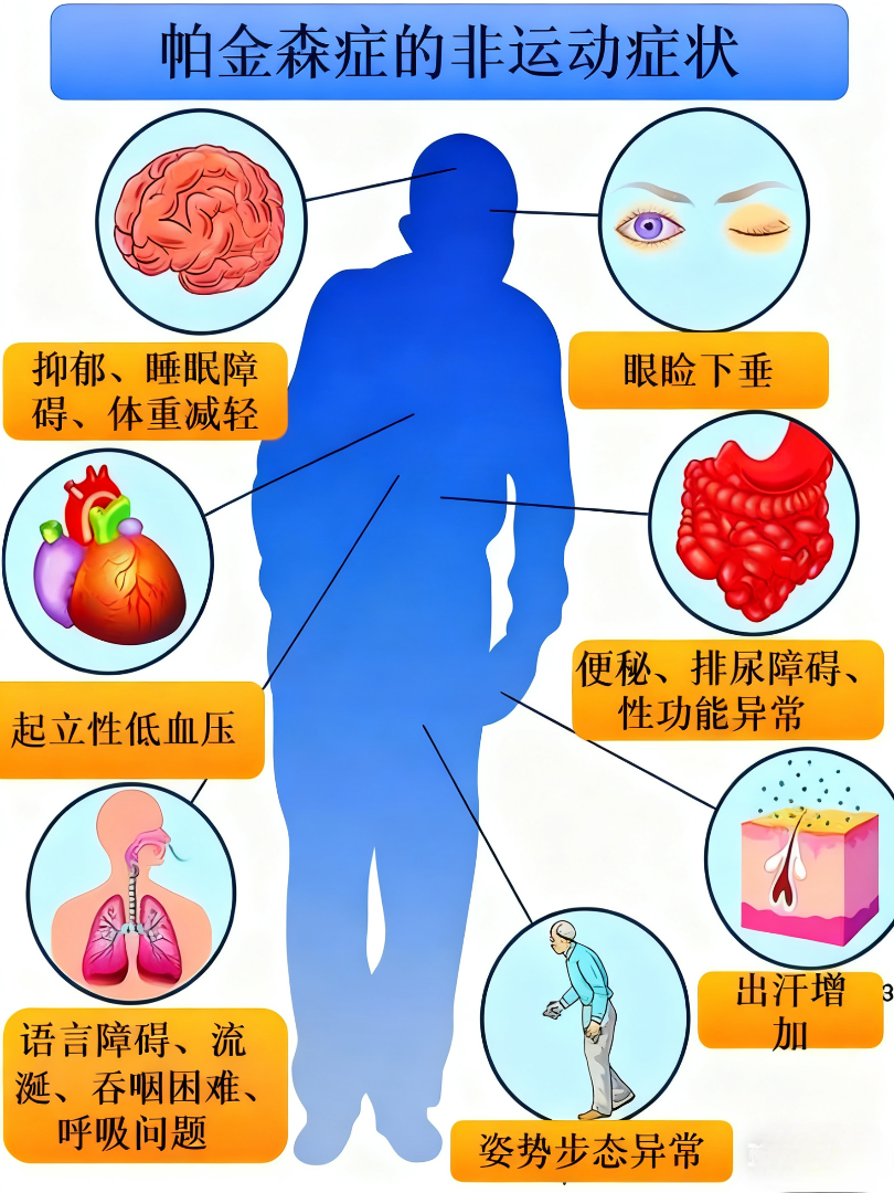 帕金森病：从病理机制到临床管理的全面解析