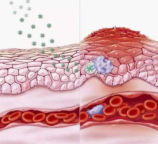 炎症是癌症的祸根，长期慢性炎症会唤醒体内“休眠”的癌细胞，这个消炎方法真的值得参考