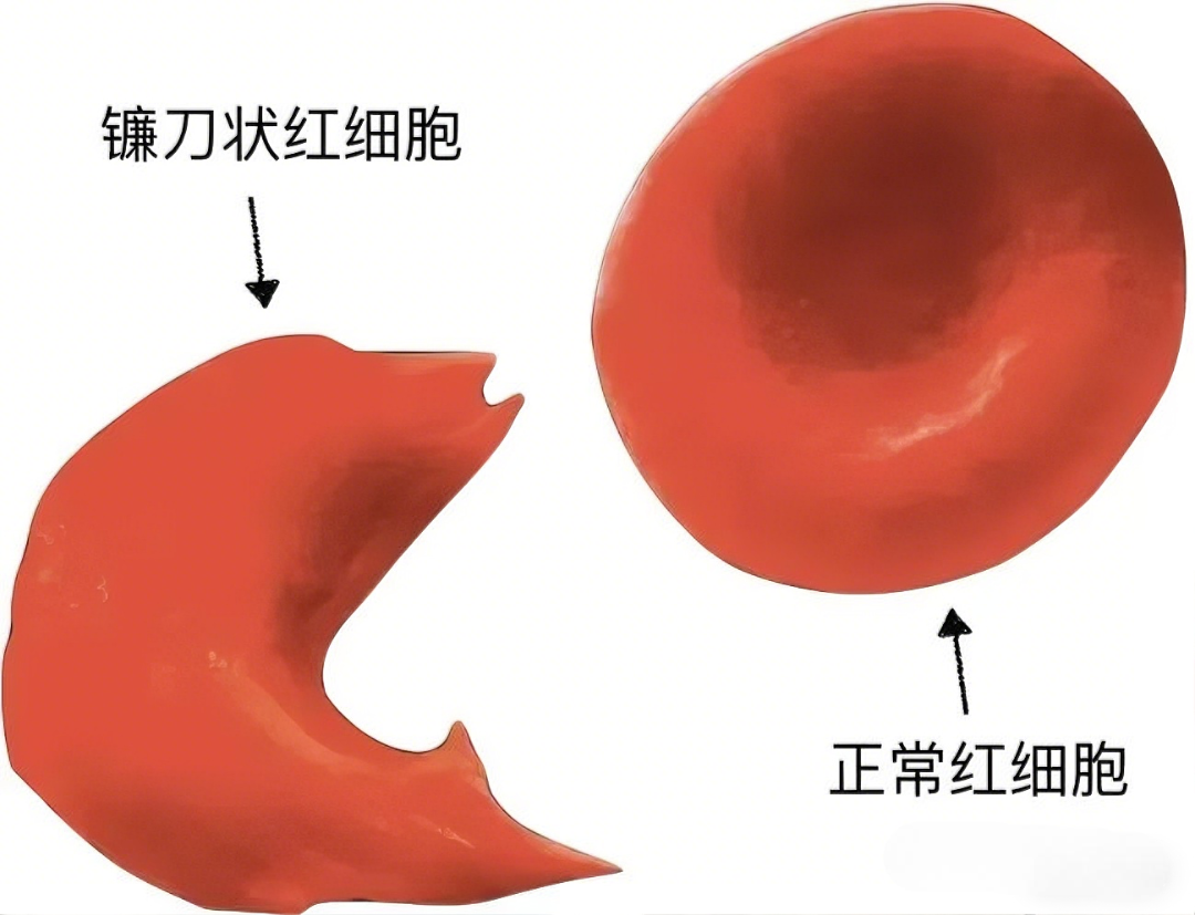 镰刀型细胞贫血病：从分子病理到临床管理