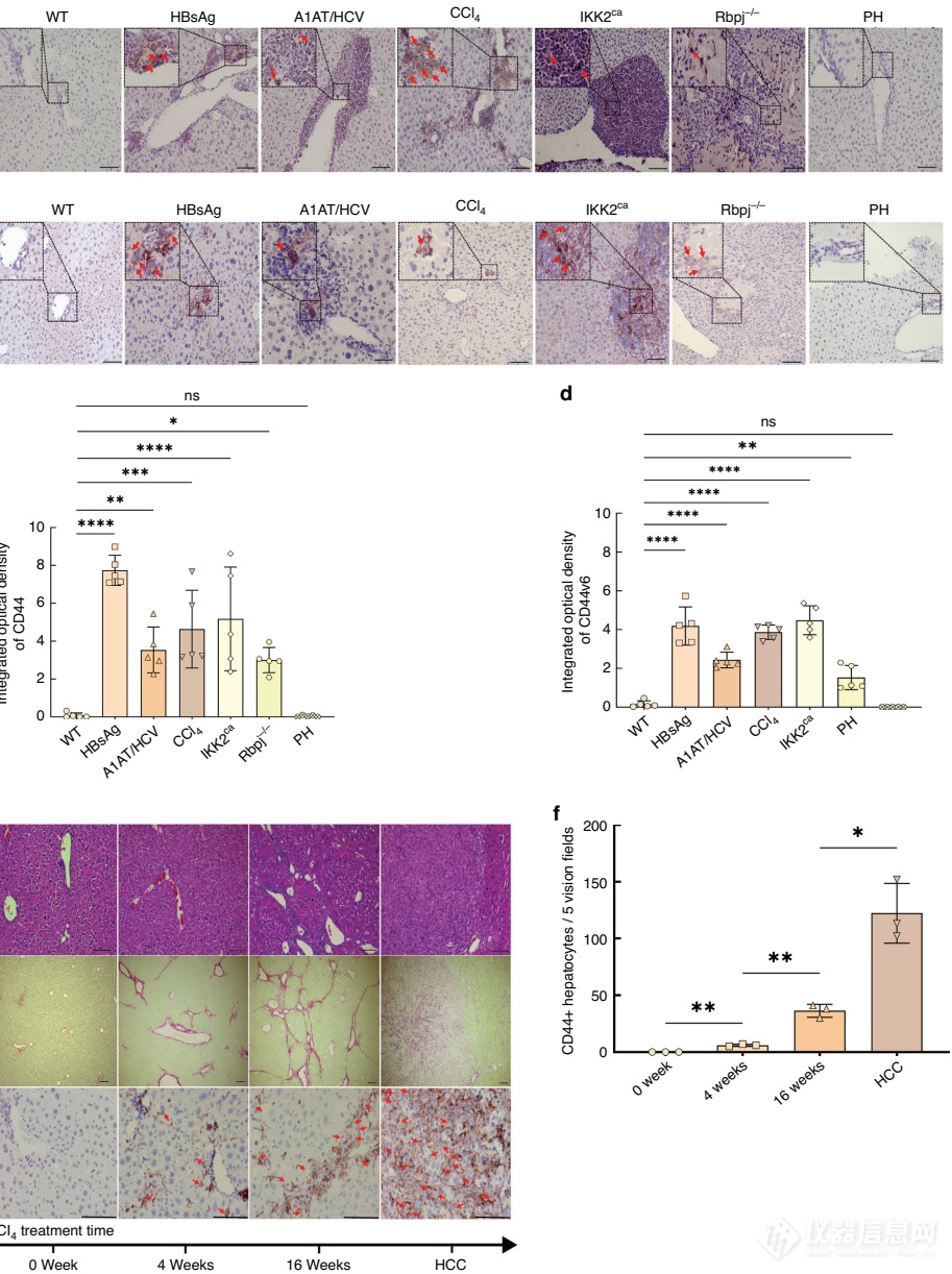 CD44上调作为慢性肝病恶性转化的早期生物标志物：从纤维化到肝癌的分子桥梁及其预后价值