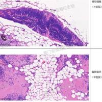 成瘤性检测（畸胎瘤）