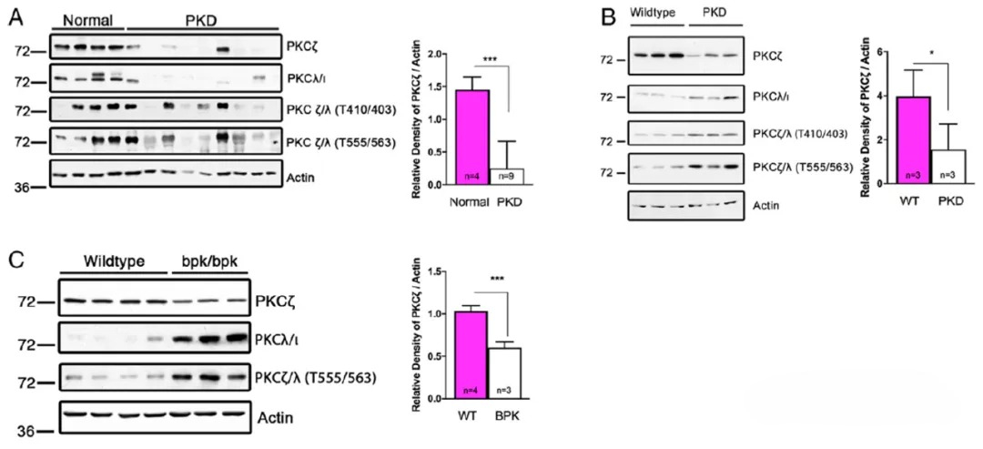 PKCζ如何调控常染色体显性多囊肾病的疾病进程？