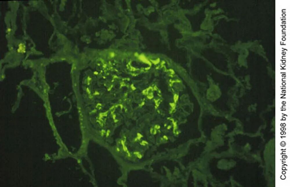 甄准速递 | 直击 IgA 肾病 “四重打击”多款新药带来治疗新选择