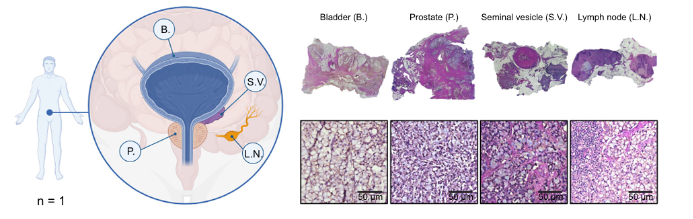 DVP实战录｜印戒细胞癌的空间细胞类型特异性蛋白质组学分析锁定其特征标志