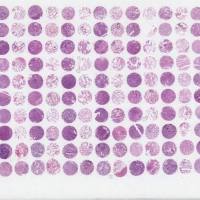 中晚期肺腺癌组织芯片