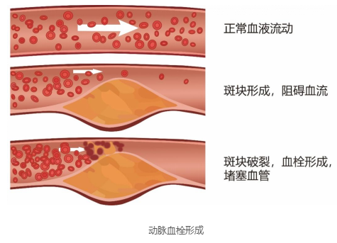 血栓治疗药物---抗凝药分析