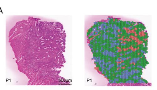 IF 33.9 顶刊突破！宫颈癌免疫抑制机制被破解，联合治疗迎来重大破局