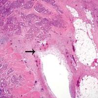 结直肠癌类器官