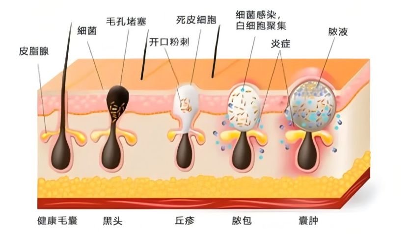 湿疹、玫瑰痤疮总复发？问题不在“消炎”，而在你的皮肤菌群！