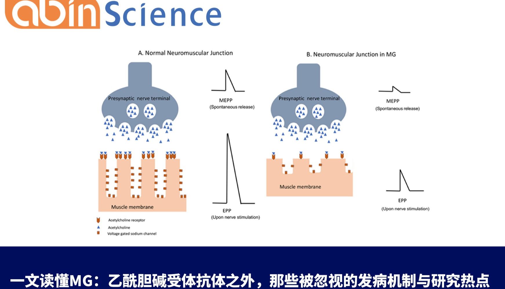 一文读懂MG：乙酰胆碱受体抗体之外，那些被忽视的发病机制与研究热点