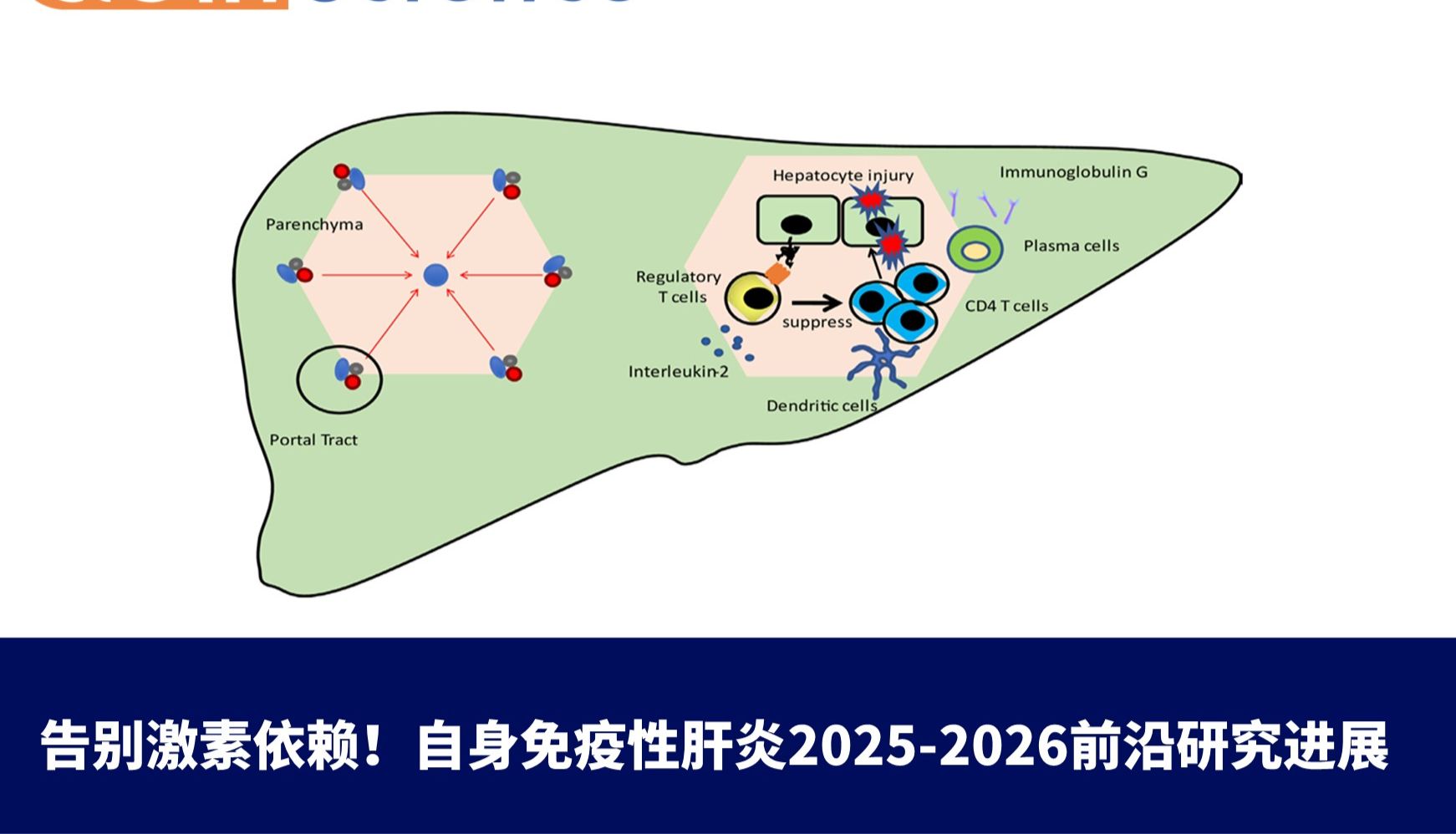 告别激素依赖！自身免疫性肝炎2025-2026前沿研究进展