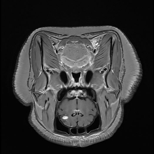 小型猪脑胶质瘤模型构建