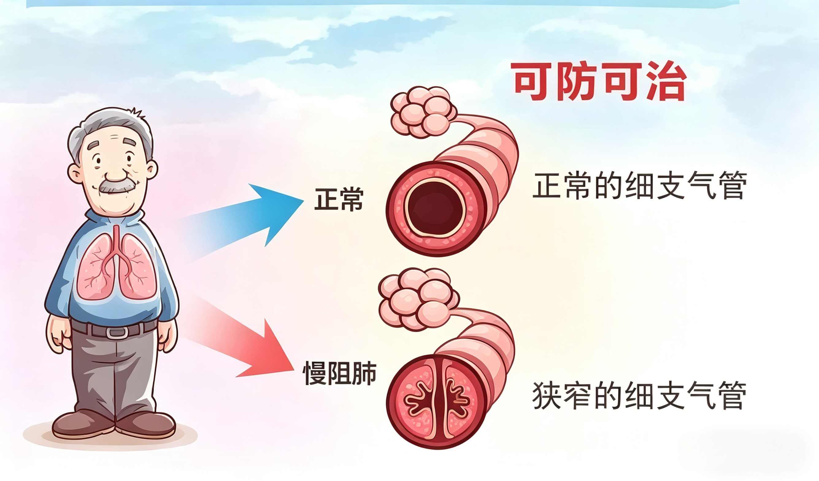 破译COPD的分子密码：生物标志物与多因子检测技术研究进展