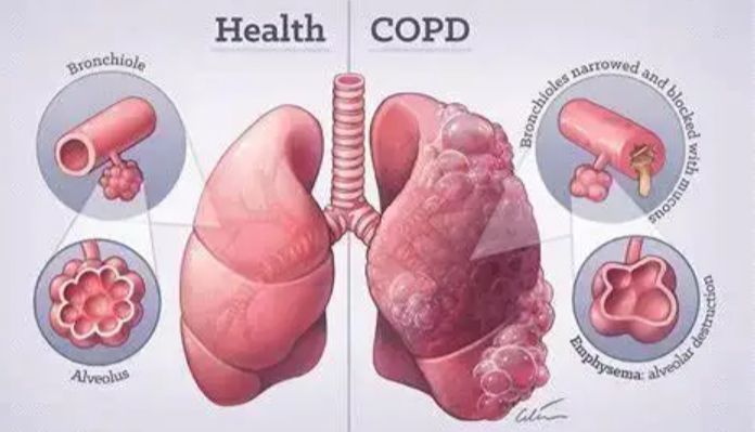 德伯COPD造模系统——总有一款匹配你的需求