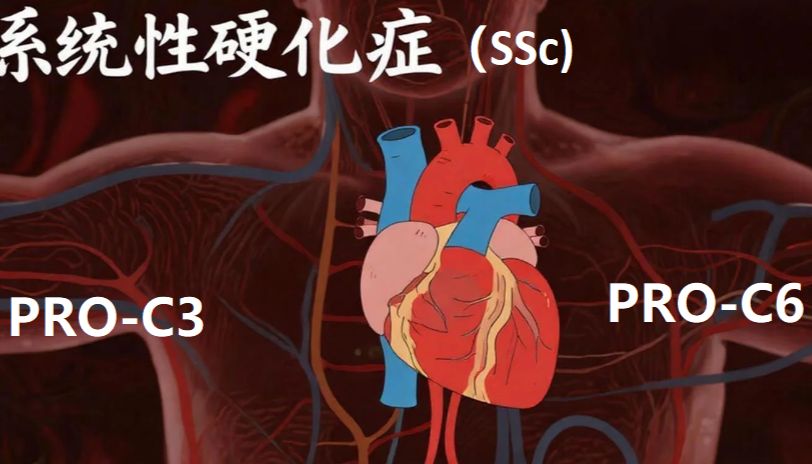 【学术速递】血清胶原代谢标志物提示系统性硬化症心脏亚临床受累
