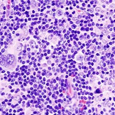 HDLM-2：霍洁金淋巴瘤细胞