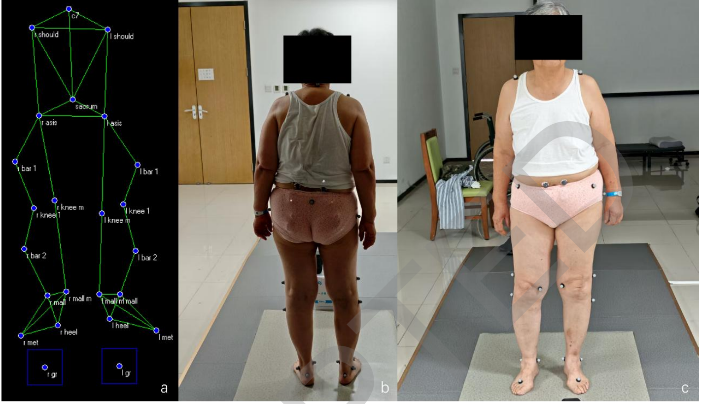 菲兹曼 × 首都医科大学宣武医院骨科：三维步态 + 表面肌电解锁脊柱退变疾病精准评估新范式