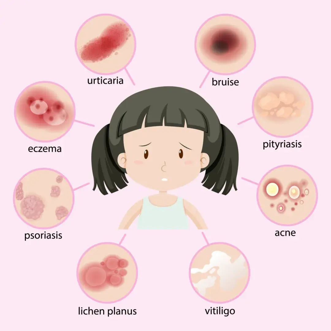 化脓性汗腺炎