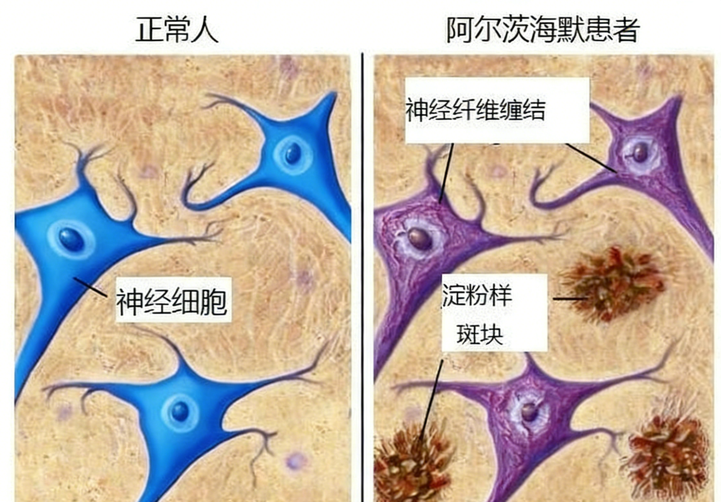 阿尔茨海默病抗体如何解码病理蛋白密码？