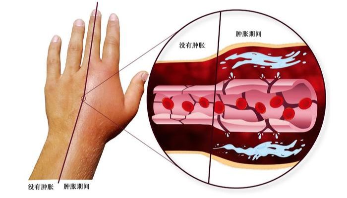 遗传性血管性水肿临床表现、发病机制及相关指标产品推荐