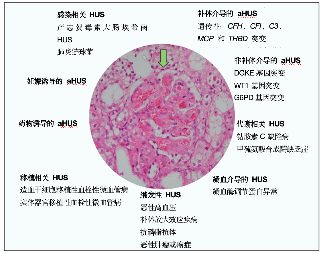 溶血尿毒综合征