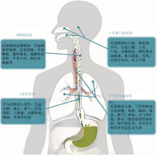 胃食管反流病