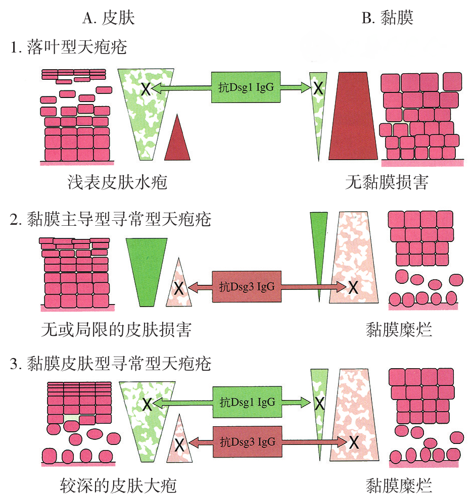 寻常型天疱疮