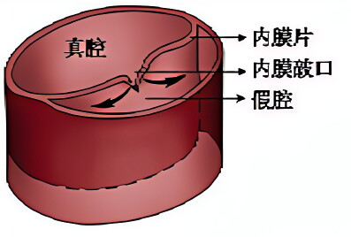 急性主动脉夹层