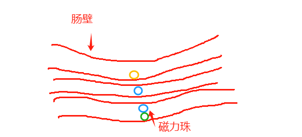 【科普】惊！5 岁女孩吞下磁力球引发肠穿孔，险送命