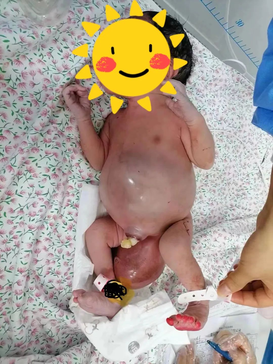 【科普】惊！生产在即，胎儿却出现肠穿孔......