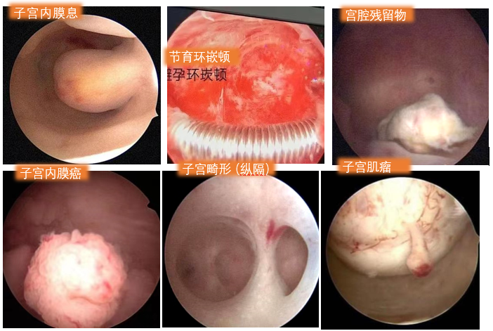 【科普】要做宫腔镜检查了，好紧张，怎么办？