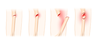 罗医骨科 | 关于骨折内固定术，你想了解的都在这里