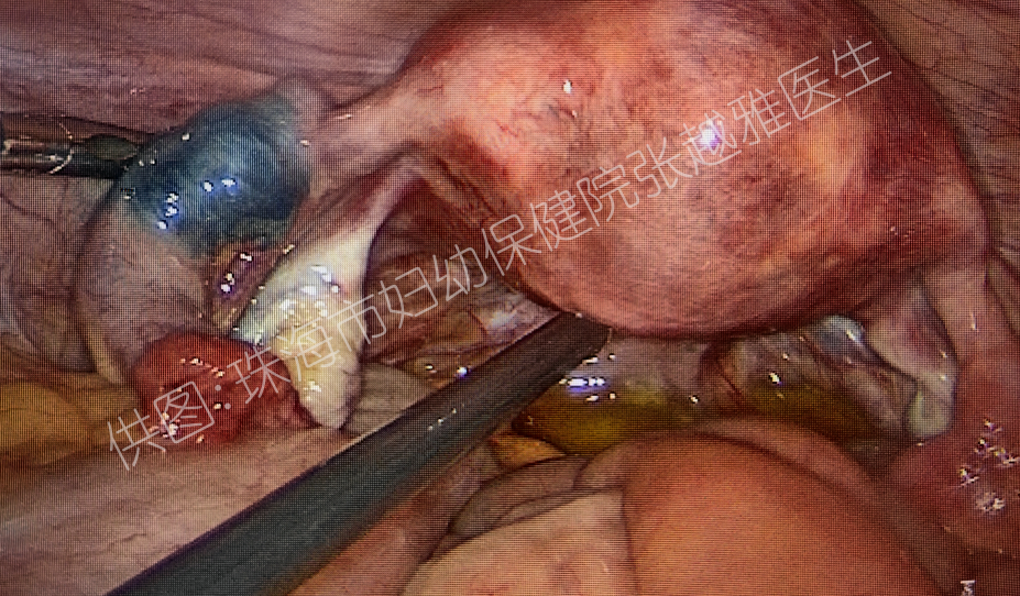 【科普】备孕「拦路虎」：输卵管憩室