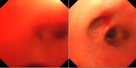 【科普】孩子贫血，竟然是因为肺出血了
